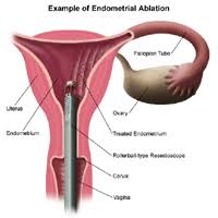 endometrial ablation hysterectomy