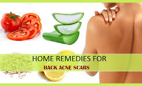home remes for back acne scararks