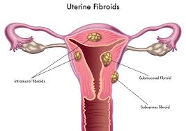 after uterine fibroid embolization