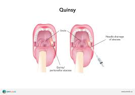 peritonsillar abscess quinsy ent info