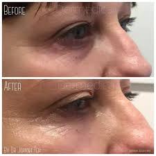 Eyes are the mirrors of the soul, or so they say. How Does Restylane Dermal Filler Work For Treating Under Eye Bags Or Puffiness In Tear Trough Area Quora