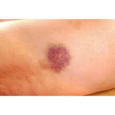 Maybe you would like to learn more about one of these? Treat Bruised Skin With Topical Vitamin K