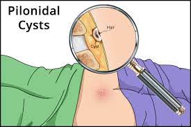 9 home remes for pilonidal cysts
