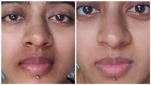 pigmentation treatment for mouth