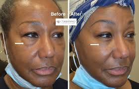 lower blepharoplasty before and after