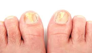 fungal nail infections feet in focus