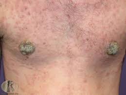 Image result for Eczema