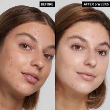 salicylic acid acne pore cleanser