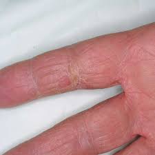 atopic dermais eczema on the hands