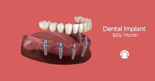 full mouth dental implants cost and