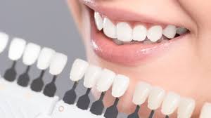 teeth whitening can be permanent here