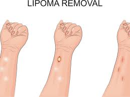 gain freedom from lipoma solomon