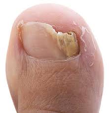 why is my toenail ed toenail