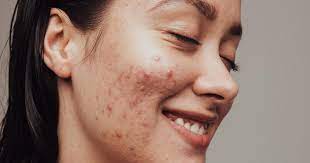 the only way to manage hormonal acne as