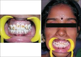 Dental fluorosis is a common disorder, characterized by hypomineralization of tooth enamel caused by ingestion of excessive fluoride during enamel formation. Fluorosis Varied Treatment Options Abstract Europe Pmc