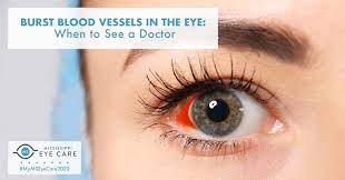 burst blood vessels in the eye when to