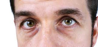 eye swelling causes symptoms treatment