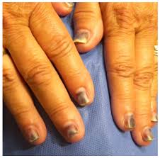contact dermais in nail cosmetics