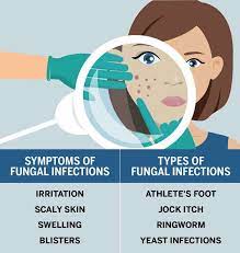 treatment for fungal infection