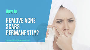 how to remove acne scars permanently