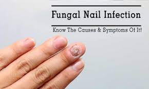 improving nail health