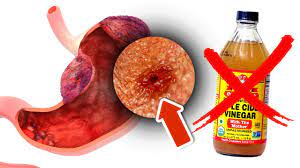 8 side effects of apple cider vinegar