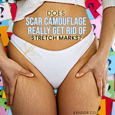 does scar camouflage really get rid of