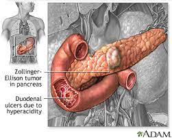 peptic ulcer disease stomach ulcers