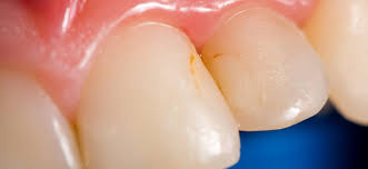 Especially in the u.s., there is less and less tolerance these days for how to remove tough stains from teeth. Tooth Discoloration What S Behind Stained And Yellow Teeth