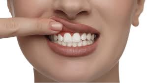 home remes to reverse gum disease
