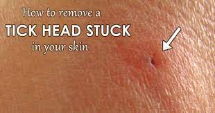 remove a tick head stuck in your skin