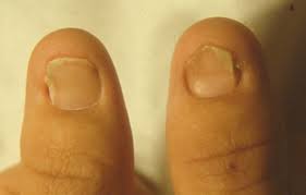 nail patella syndrome doccheck
