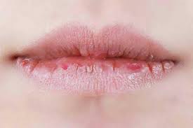 get rid of chapped lips