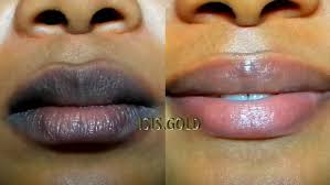 tretinoin on lips whiten dark lips