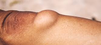 what is a lipoma symptoms causes 4