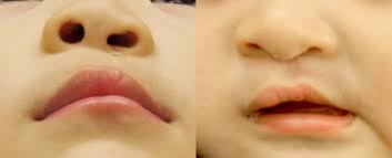cleft lip and palate treatment