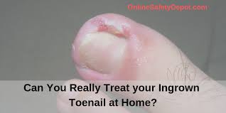 really treat your ingrown toenail