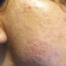 small white boils pimples after laser