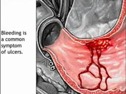 stomach ulcer animation peptic ulcer