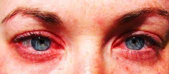 battling eye allergies royal oak eye care