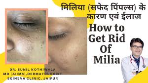 milia removal treatment in jaipur skin