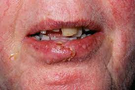 infected lacerated lip stock image