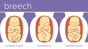 Image result for breech baby