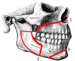 How do braces fix underbites? Orthognathic Surgery Wikipedia