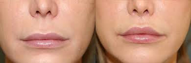 the benefits of lip lift surgery dr