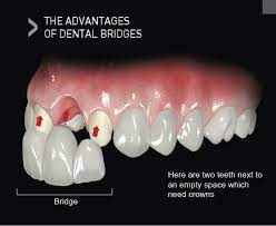 dental bridges why choose a dental