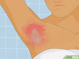 how to get rid of heal armpit rash