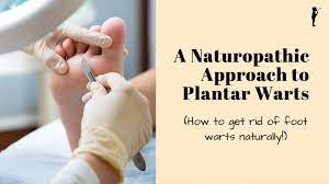 naturopathic approach to plantar warts
