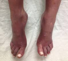 purple feet when sitting common causes