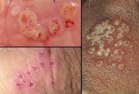 Std Pictures Herpes Genital Warts Gonorrhea Std Symptoms